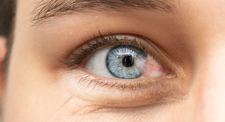 Хвороба Птеригіум