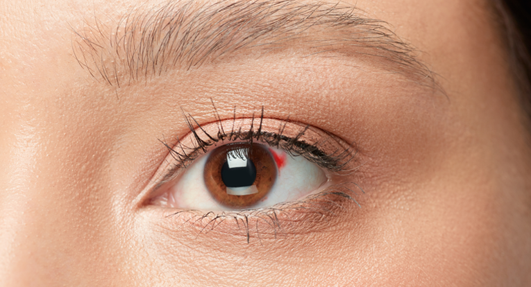 retynopatiya Хвороба Ретинопатія