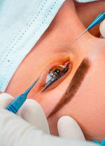 Видалення стороннього тіла із рогівки