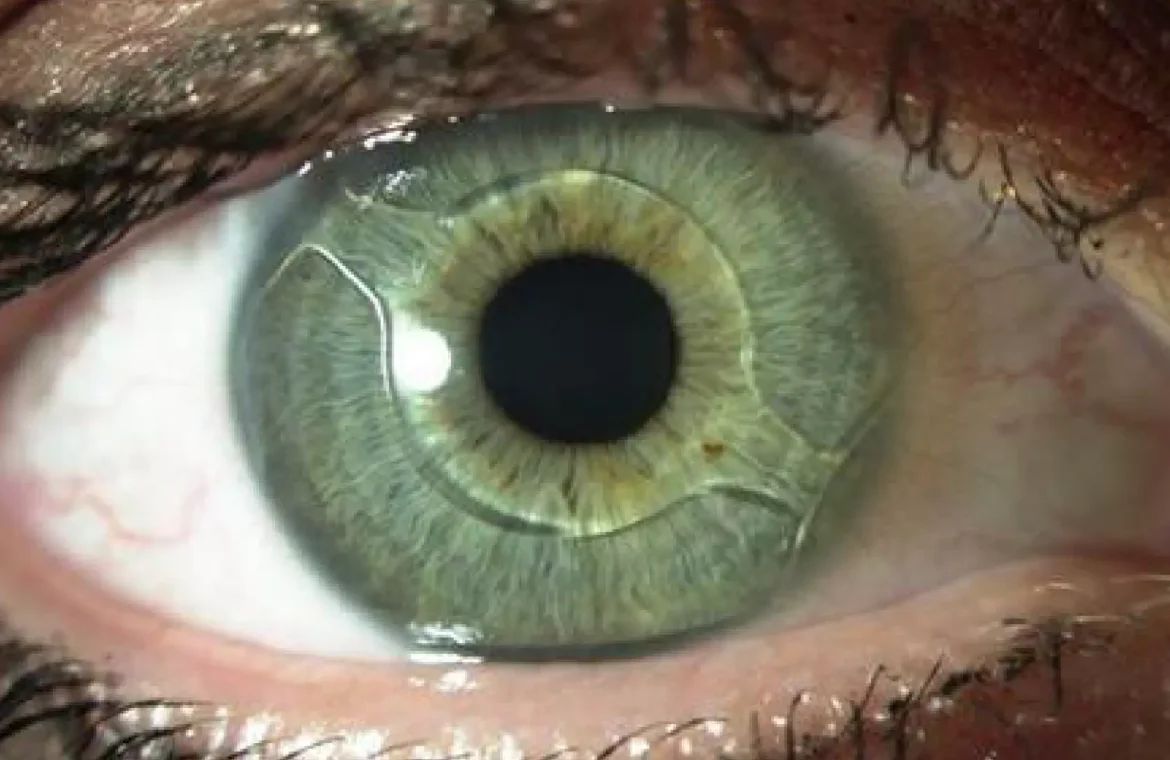 Коли міняти кришталик