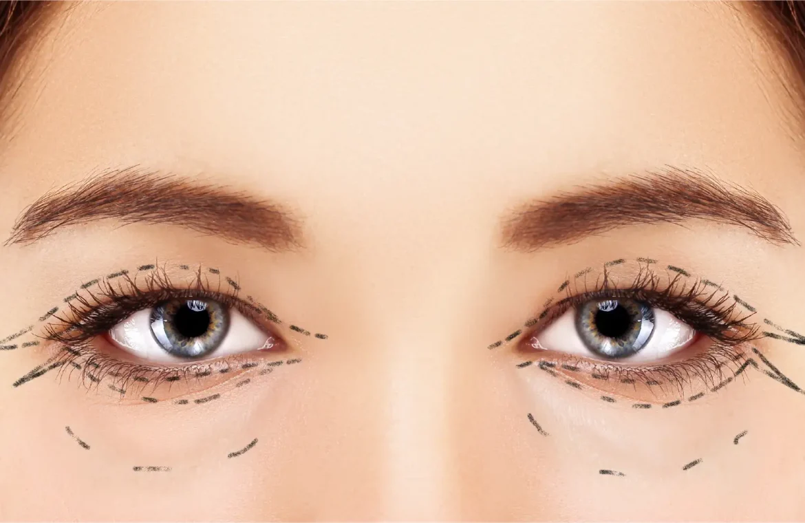 Чим небезпечна блефаропластика