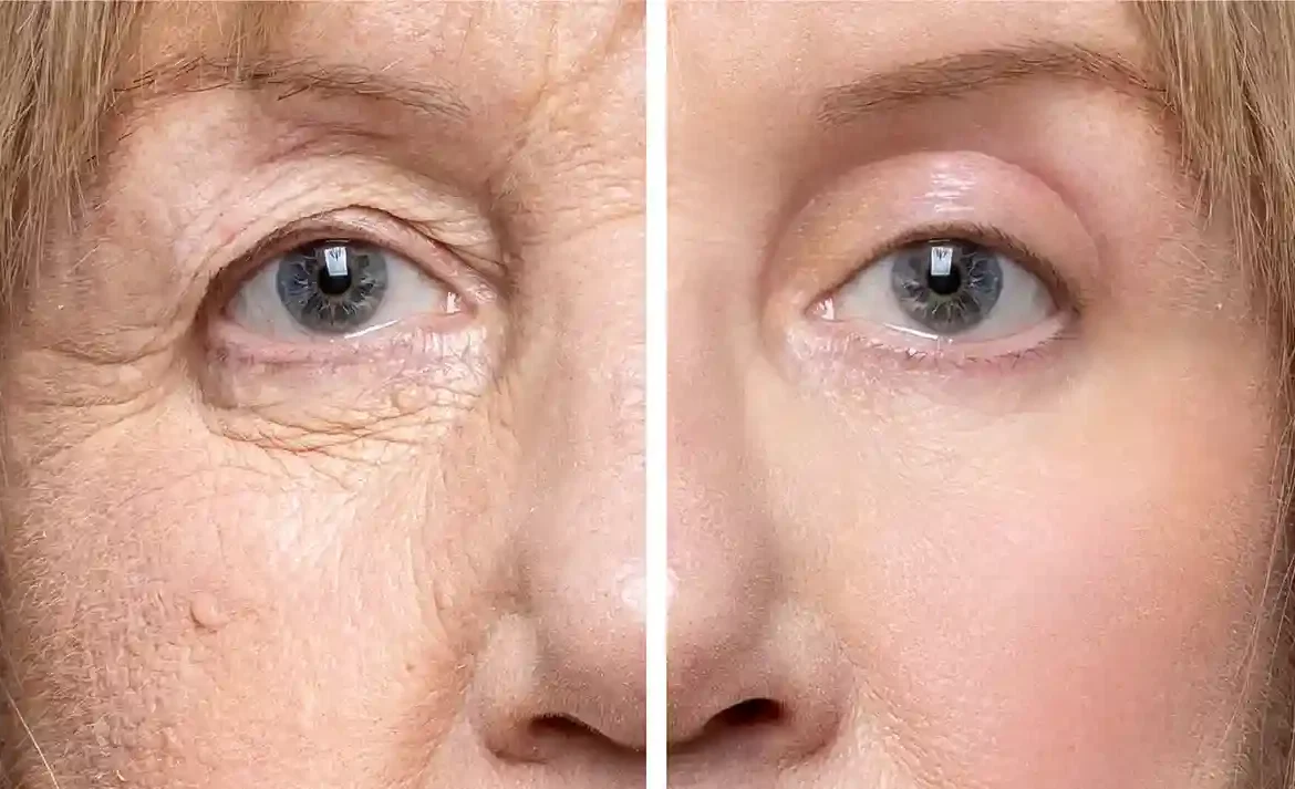 Що таке блефаропластика очей